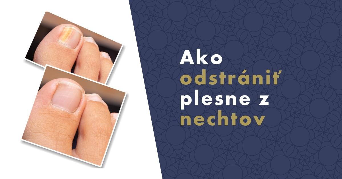 Ako odstrániť pleseň z nechtov (onychomykózu) aj bez predpisu